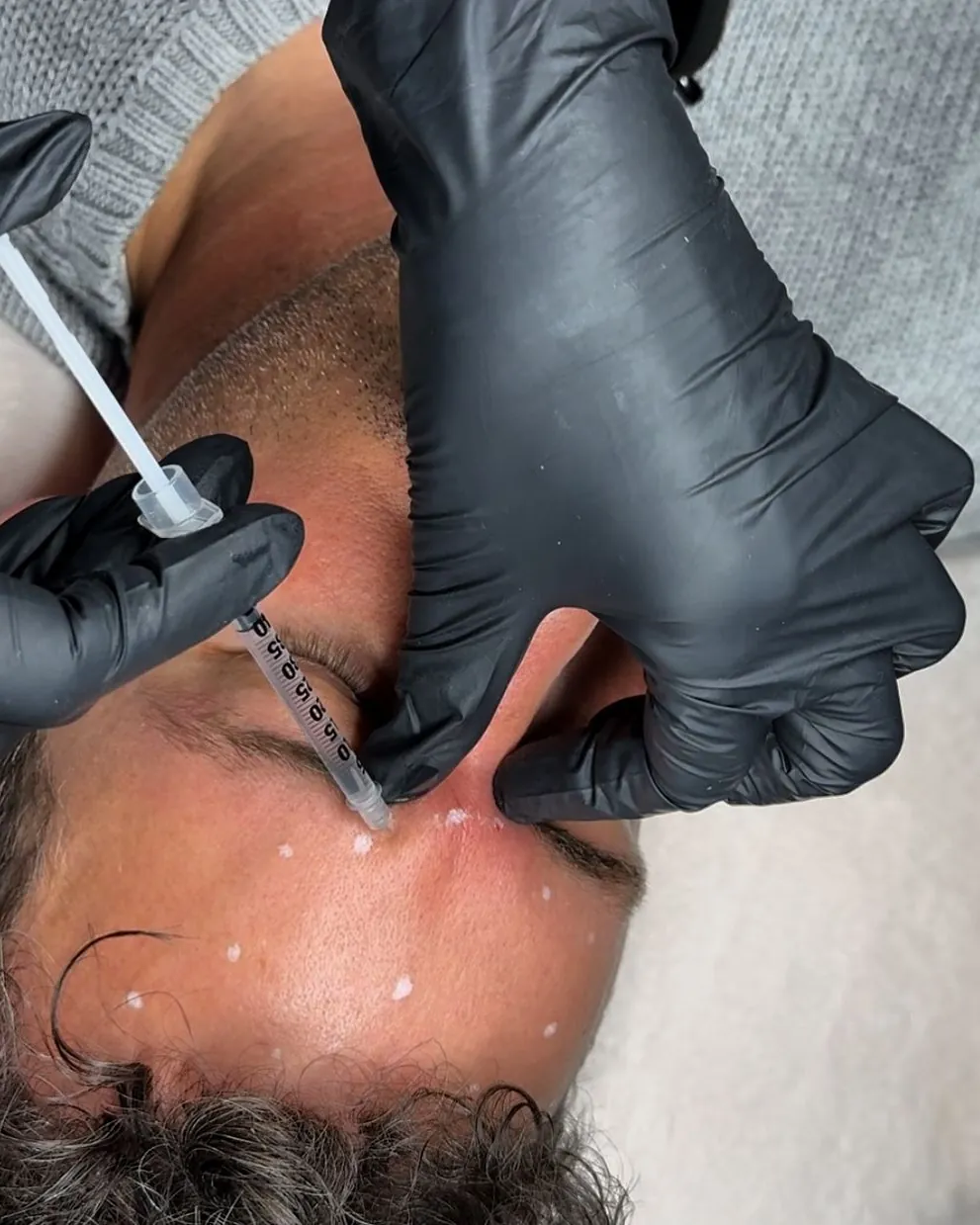 Doctor carrying out anti-wrinkle injections between the brows at Skin Story Clinic, London