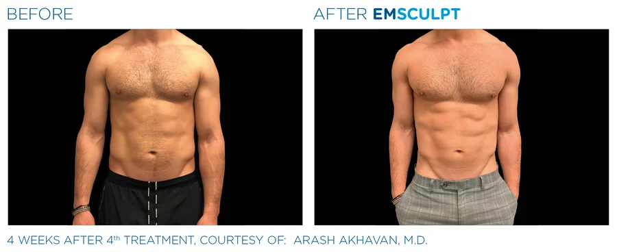 Emsculpt before and after on a man's abdomen, 4 weeks after the fourth treatment