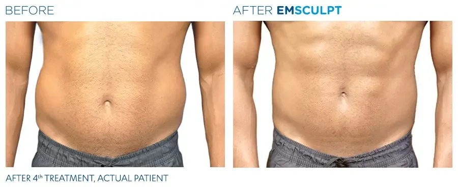 Emsculpt before and after abdominal muscle definition in a male patient