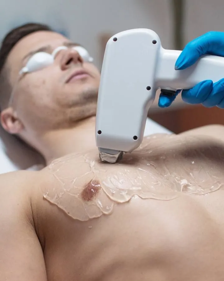 Man having laser hair removal on his chest at Skin Story Clinic, London